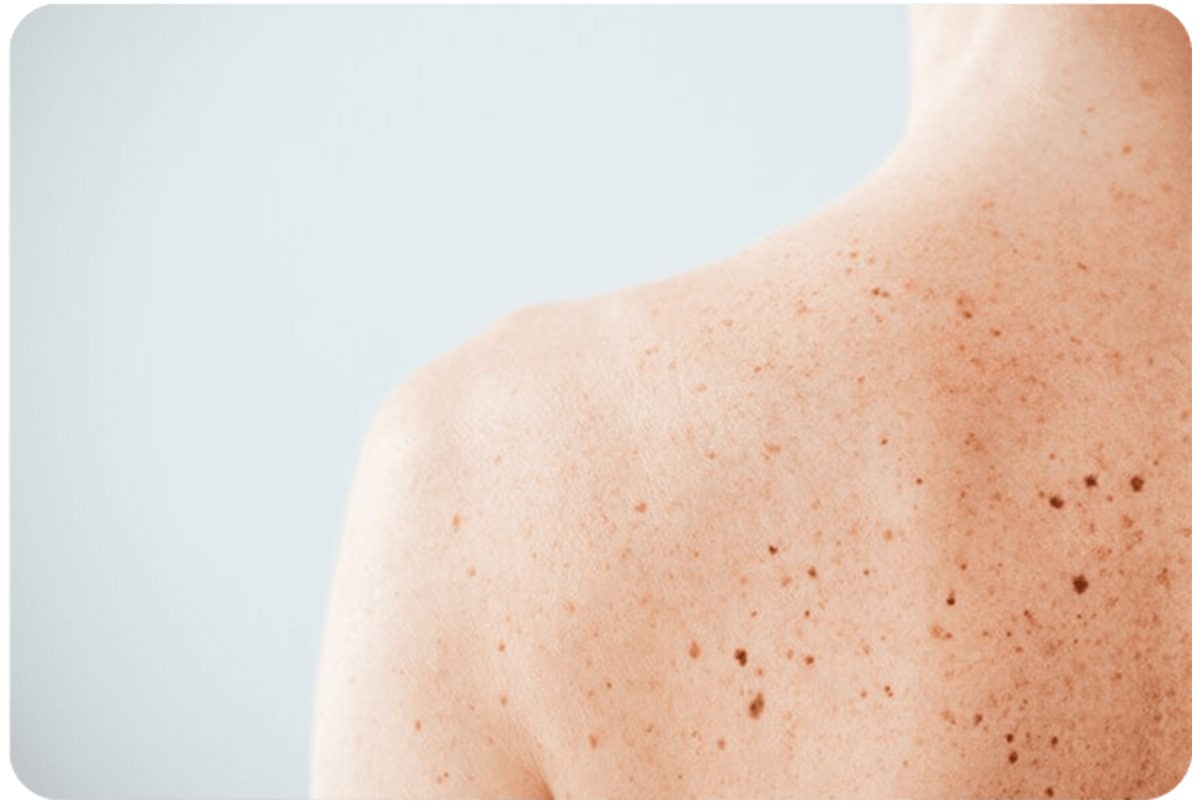 Back of woman's shoulder with freckles