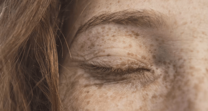 Freckles on eyelids