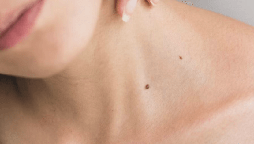 Mole on woman's neck