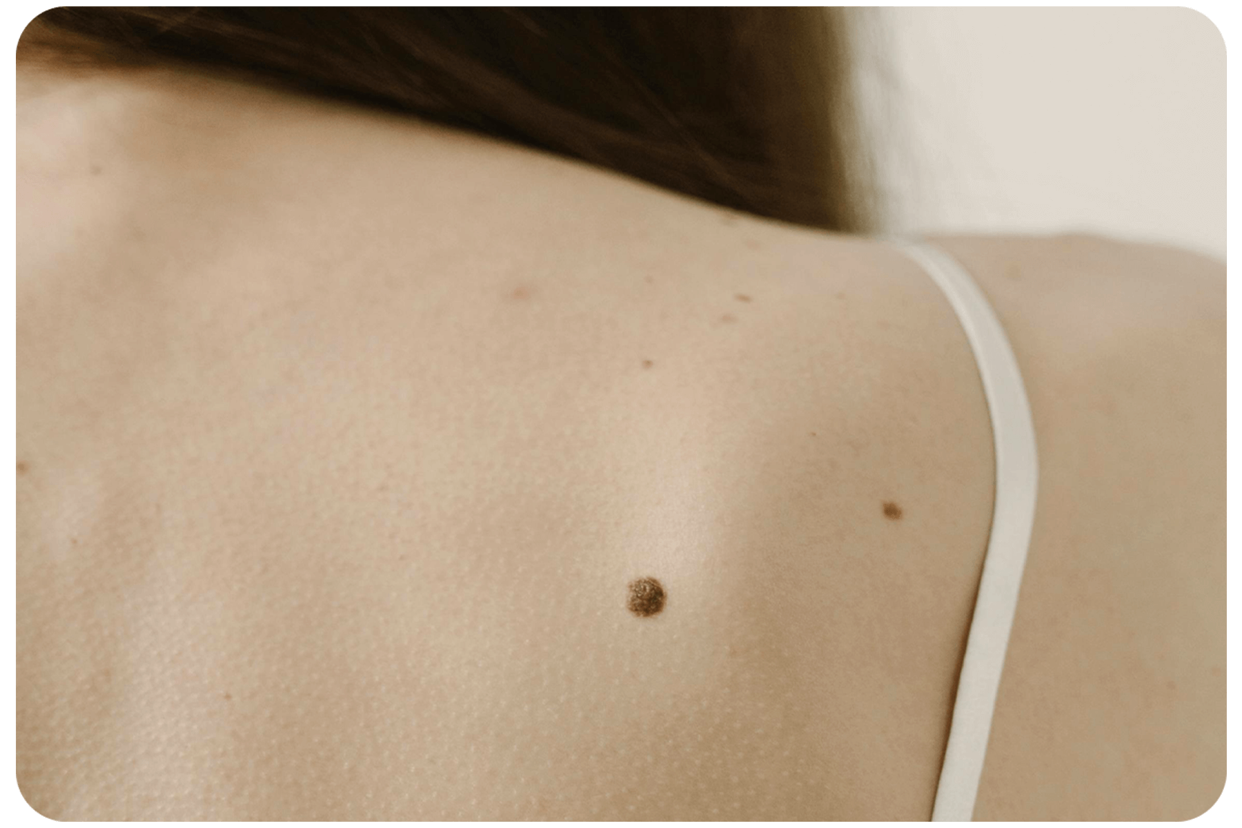 Close up of a mole on back