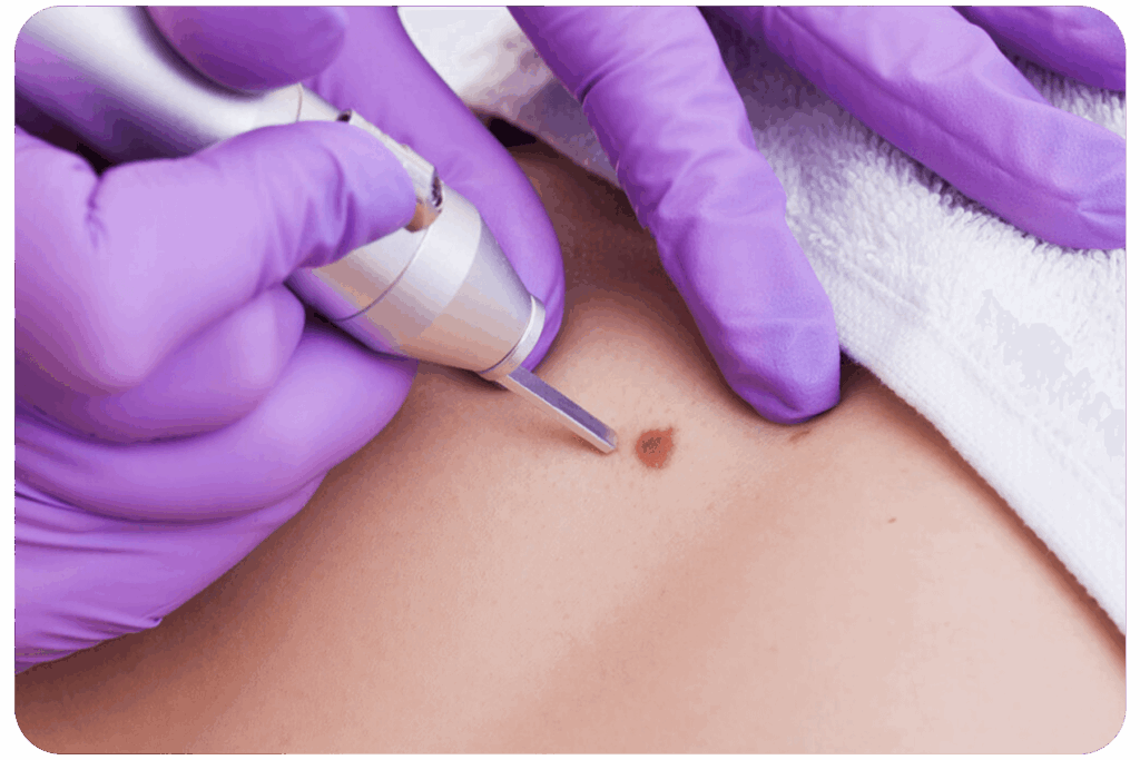 Removing a benign lesion from back