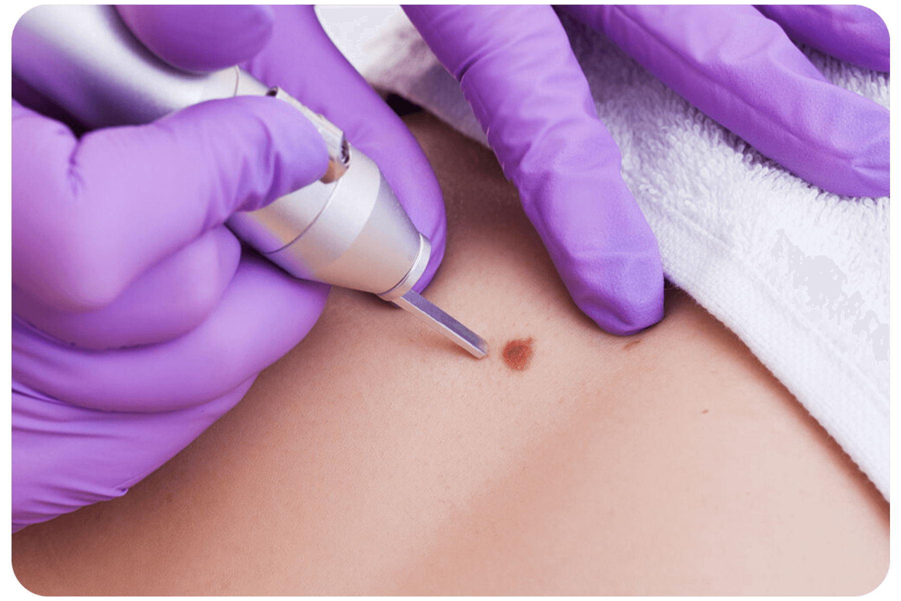 Removing a benign lesion from back