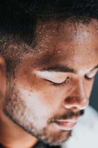 Excessive Sweating