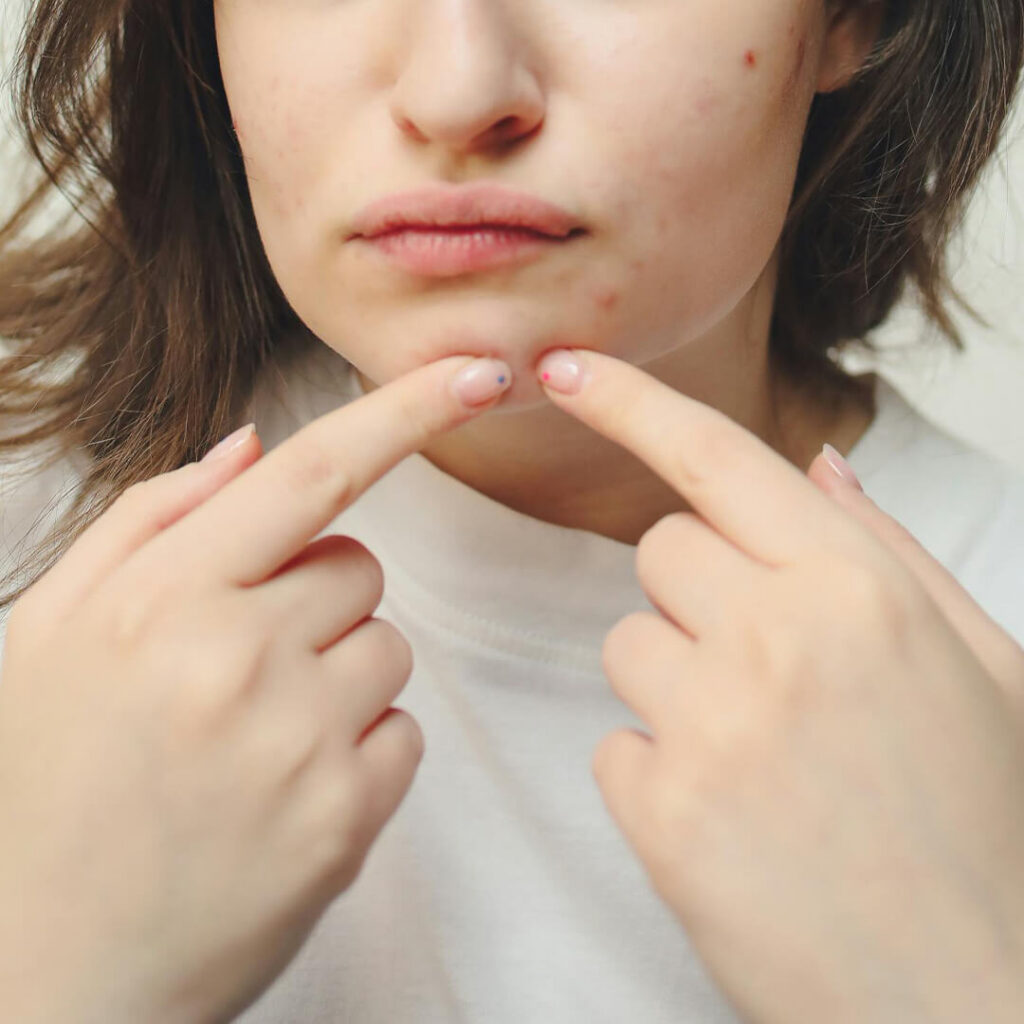 Girl popping pimple on chin