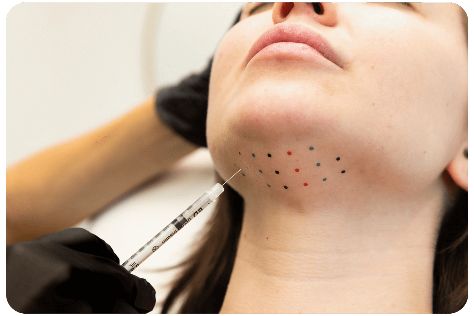 Kybella treatment grid on the underside of the chin