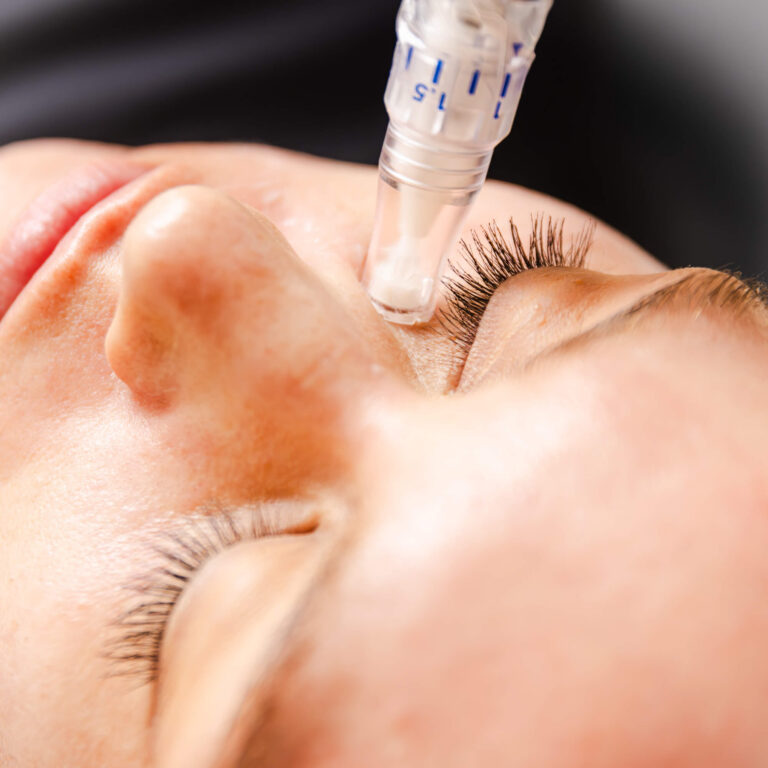 Woman getting a facial with a skinpen