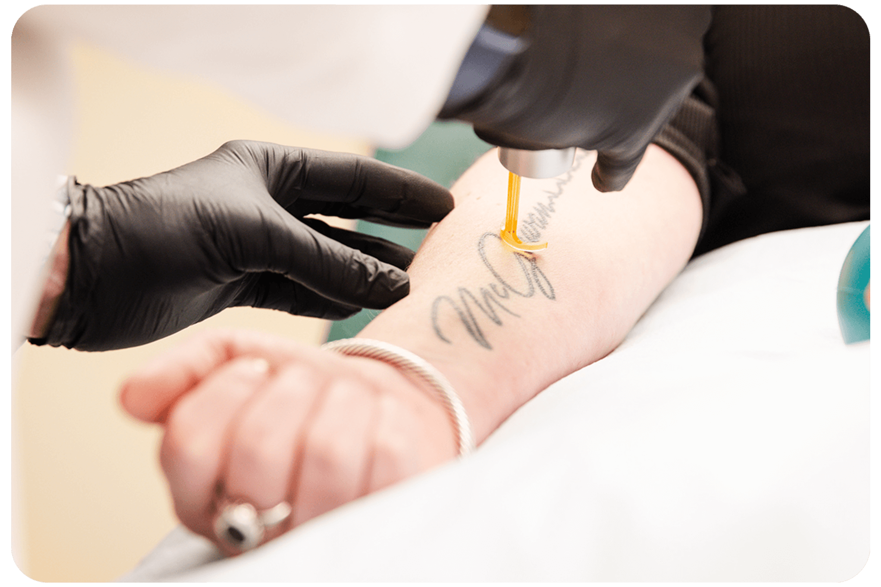 Getting a tattoo removed with PicoWay laser