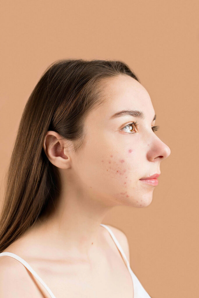 Female teen with acne