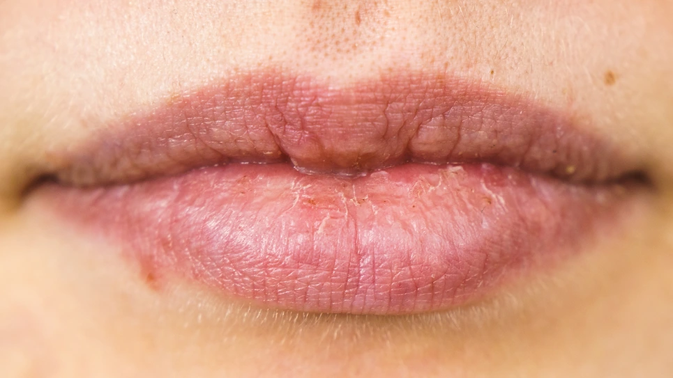 This image has an empty alt attribute; its file name is mohs-surgery-upper-lip_2.webp