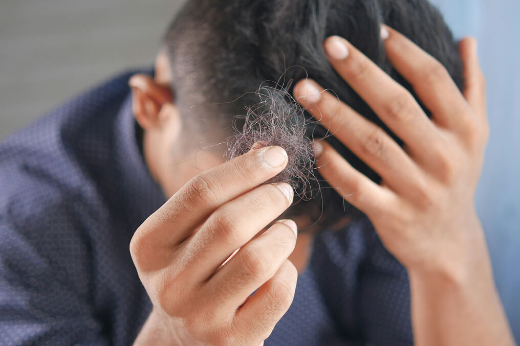 Man holding hair in hand from hairloss