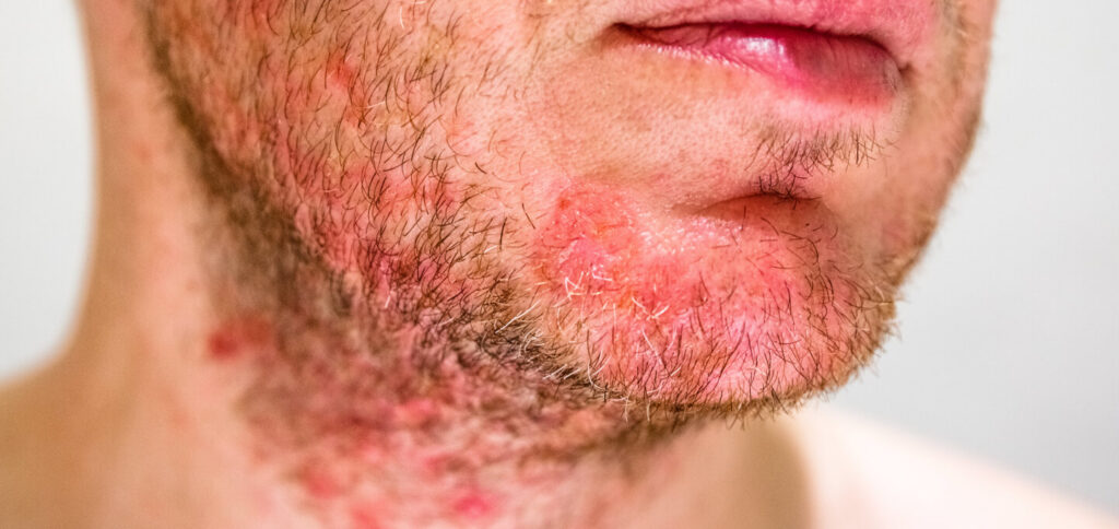 Patient with folliculitis