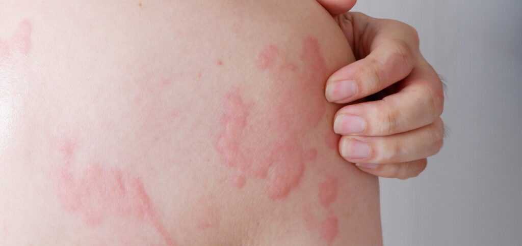 Hive breakout on skin