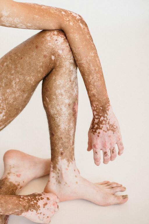 Patient with vitiligo on arms and legs