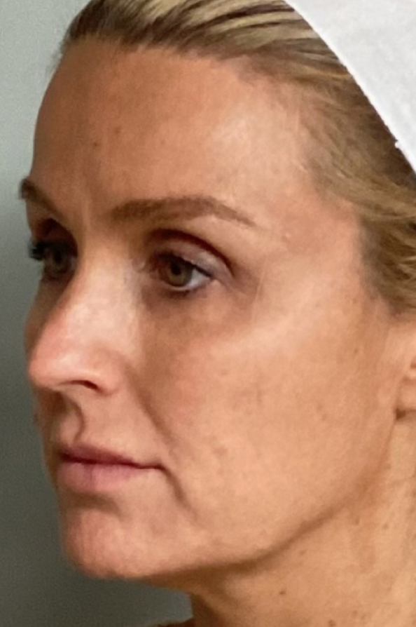 Woman's face for full facial balancing