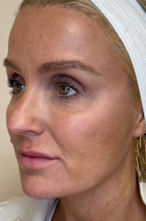Woman's face for full facial balancing