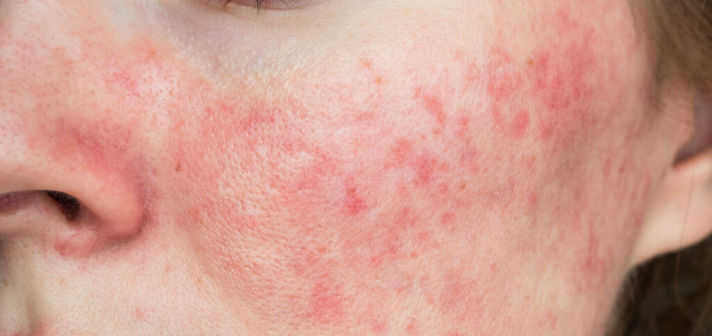 Rosacea on cheeks