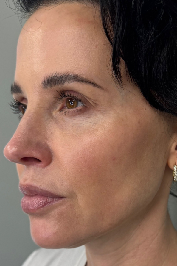 Full facial contouring and botox patient face