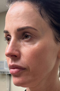 Full facial contouring and botox patient face