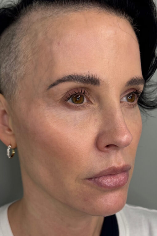 Full facial contouring and botox patient face