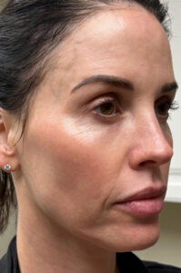 Full facial contouring and botox patient face