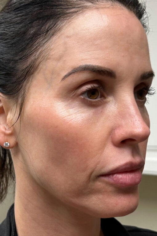 Full facial contouring and botox patient face