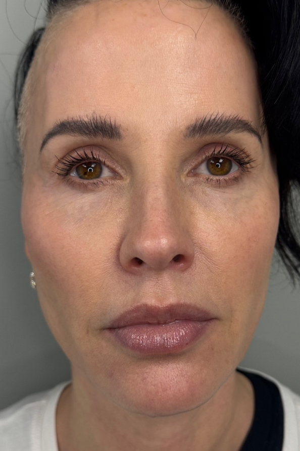 Full facial contouring and botox patient face