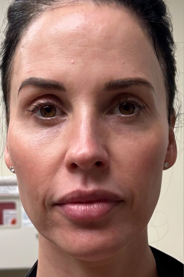 Full facial contouring and botox patient face