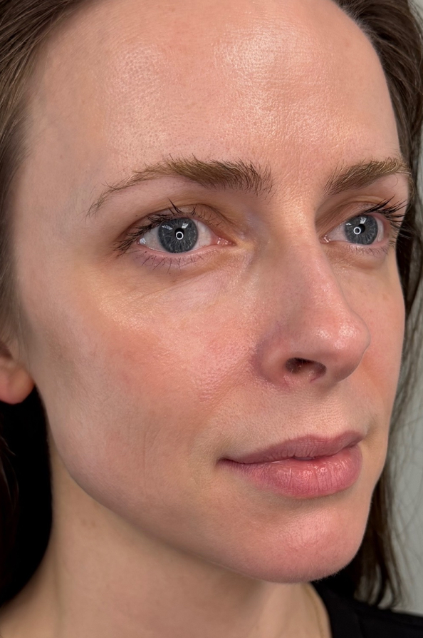 Before sculptra