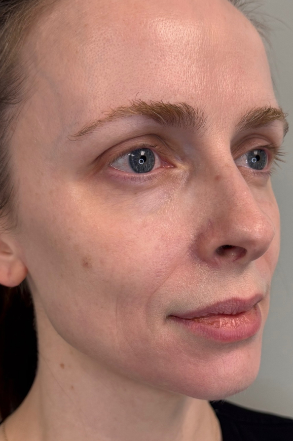 After sculptra