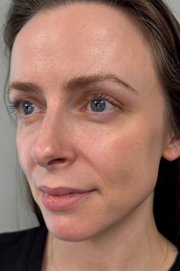 Patient after Sculptra