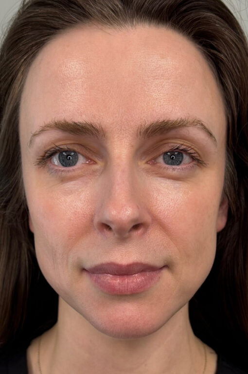 Patient with Sculptra after