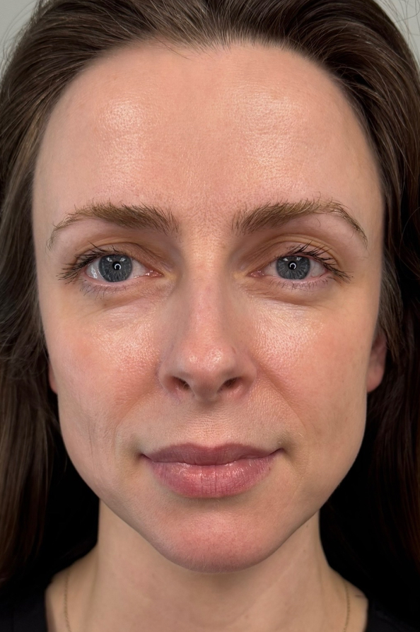 Patient with Sculptra after