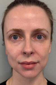 Patient face before Sculptra
