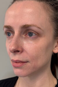 Patient before sculptra