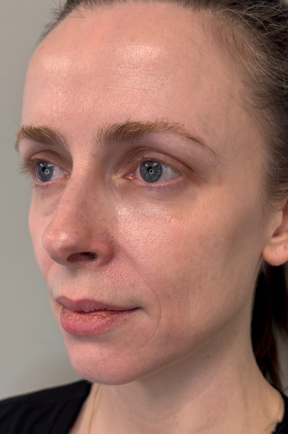 Patient before sculptra