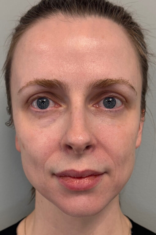 Patient face before Sculptra