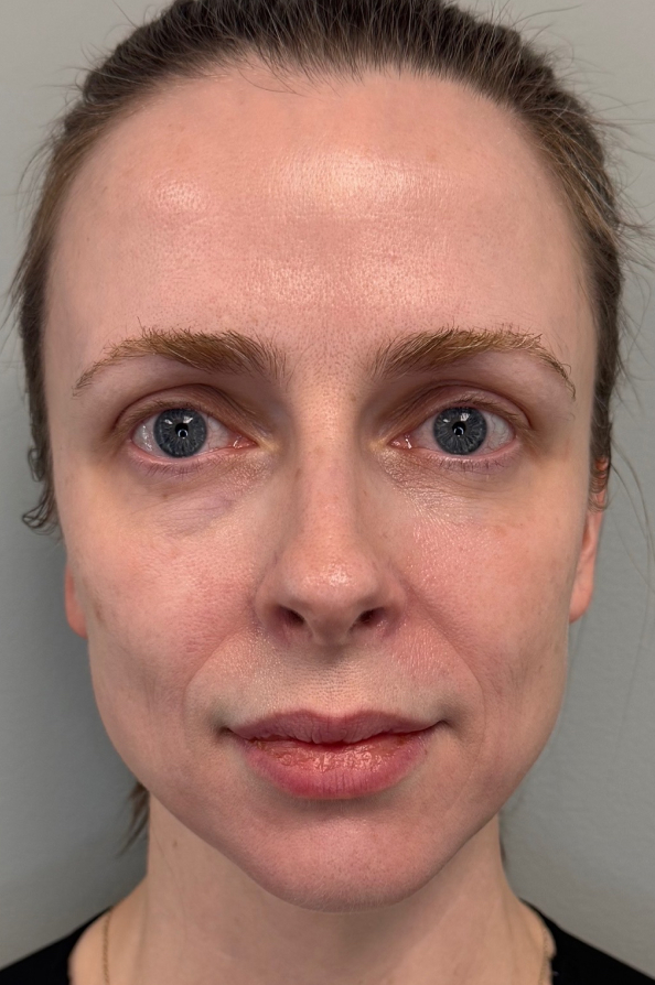 Patient face before Sculptra